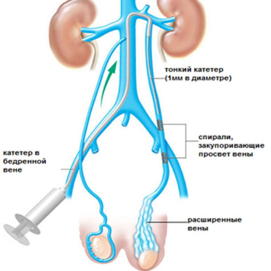 Чем опасно варикоцеле? Можно ли его заметить самому? Как лечить?