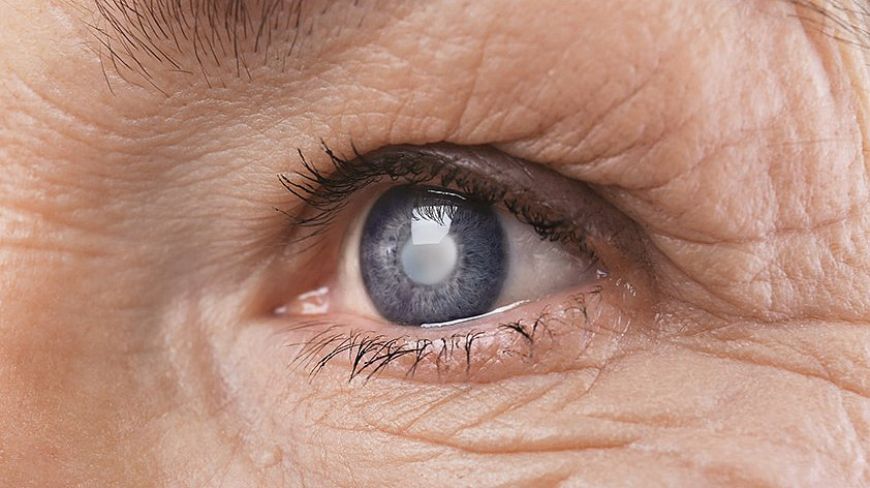 Что такое катаракта? Каковы причины, симптомы и методы лечения катаракты?