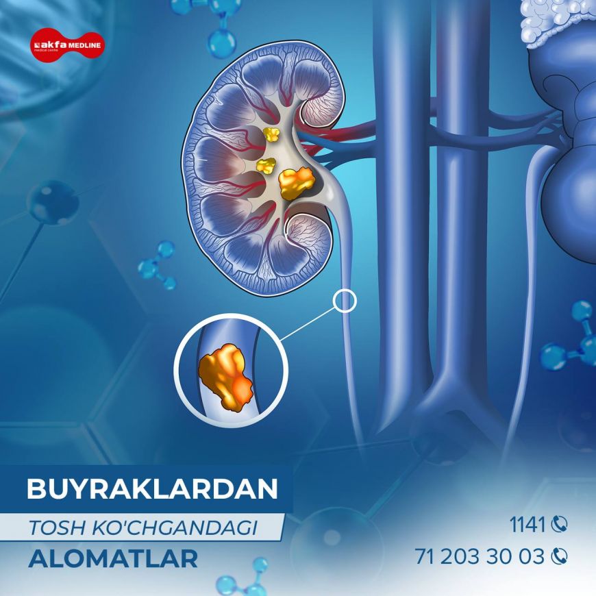 O'zingizda siydik tosh kasalligini borligiga shubha qilyabsizmi? 