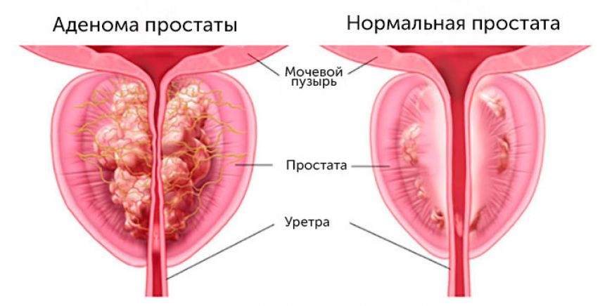 АДЕНОМАНИ ЖАРРОҲЛИК ЙЎЛИ БИЛАН ДАВОЛАШ